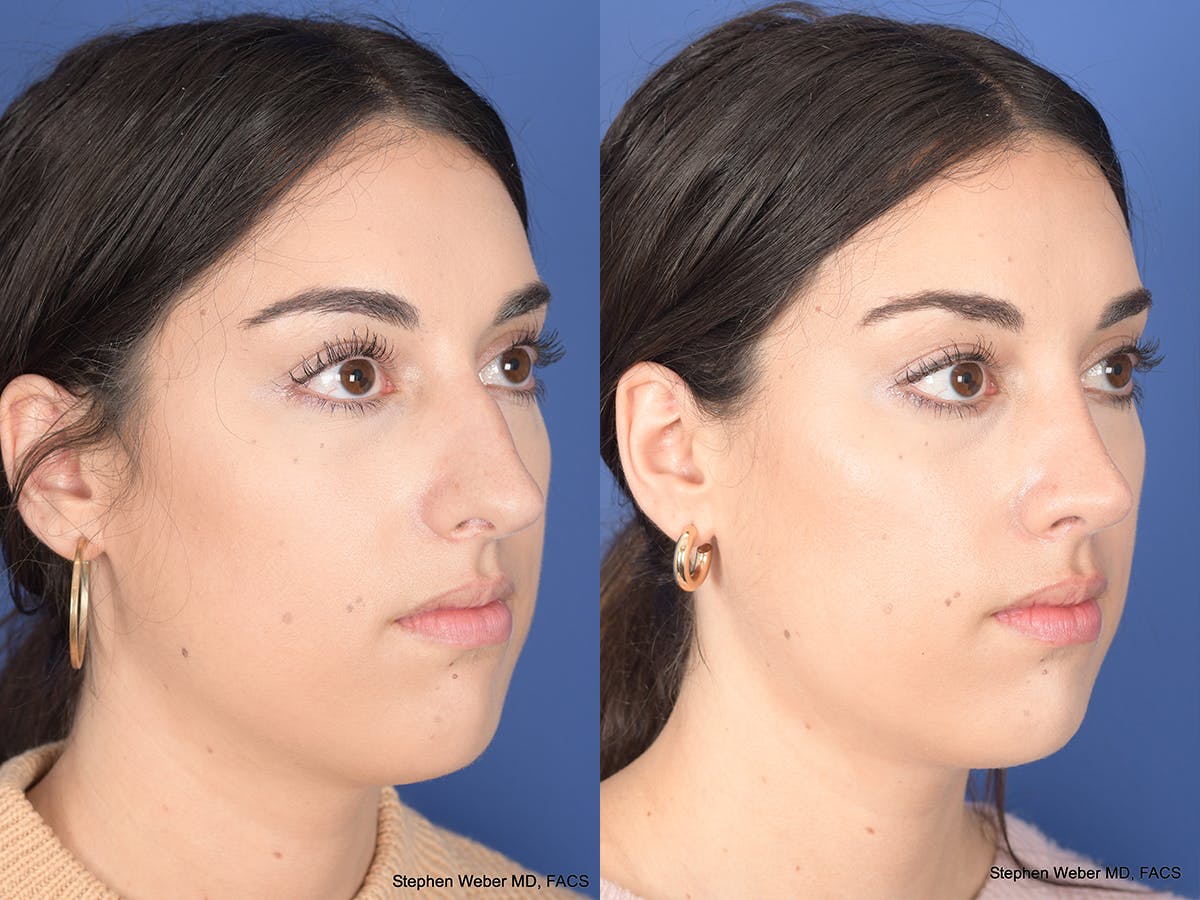 Rhinoplasty Before & After Gallery - Patient 961971 - Image 4