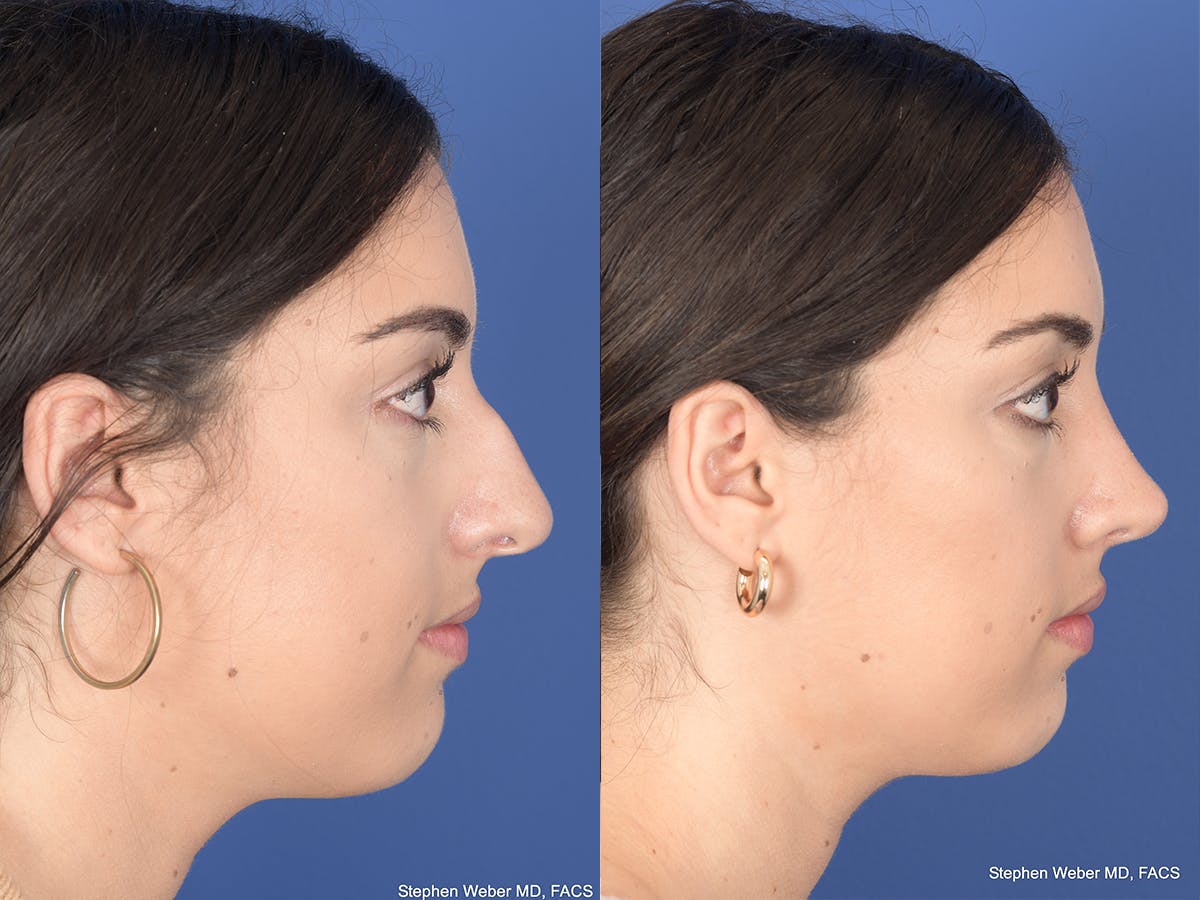 Rhinoplasty Before & After Gallery - Patient 961971 - Image 5