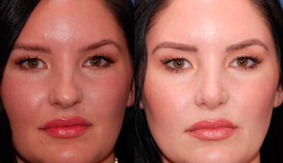 Rhinoplasty Before & After Gallery - Patient 948516 - Image 1