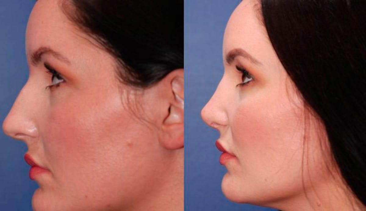Rhinoplasty Before & After Gallery - Patient 948516 - Image 2