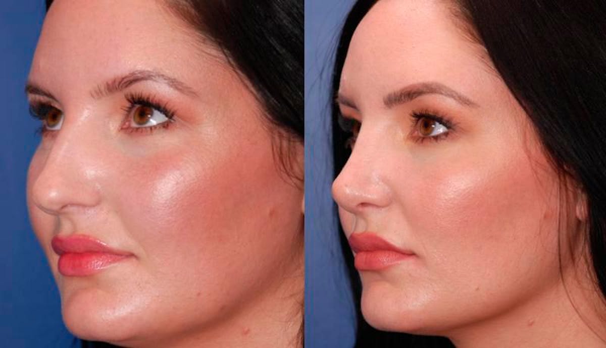 Rhinoplasty Before & After Gallery - Patient 948516 - Image 3
