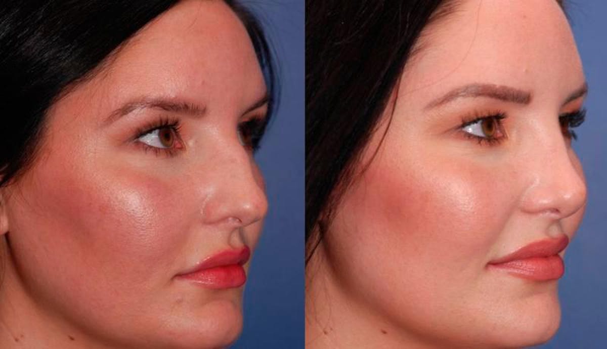 Rhinoplasty Before & After Gallery - Patient 948516 - Image 4