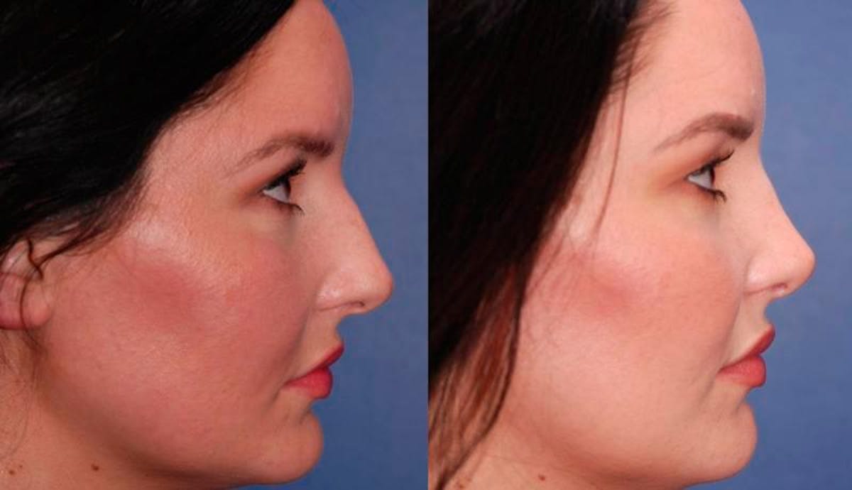 Rhinoplasty Before & After Gallery - Patient 948516 - Image 5