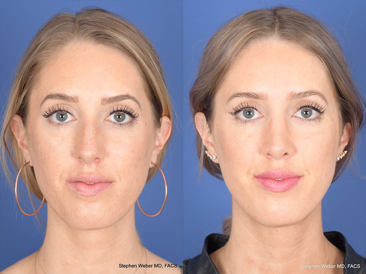 Rhinoplasty Before & After Gallery - Patient 306018 - Image 1