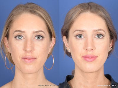 Rhinoplasty Before & After Gallery - Patient 306018 - Image 1