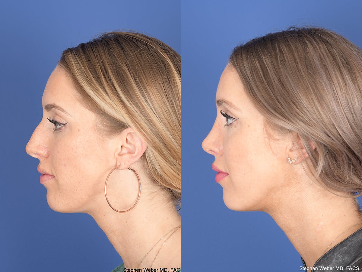 Rhinoplasty Before & After Gallery - Patient 306018 - Image 2
