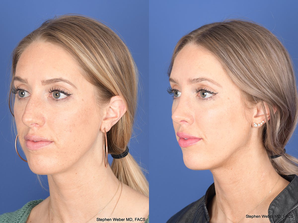 Rhinoplasty Before & After Gallery - Patient 306018 - Image 3