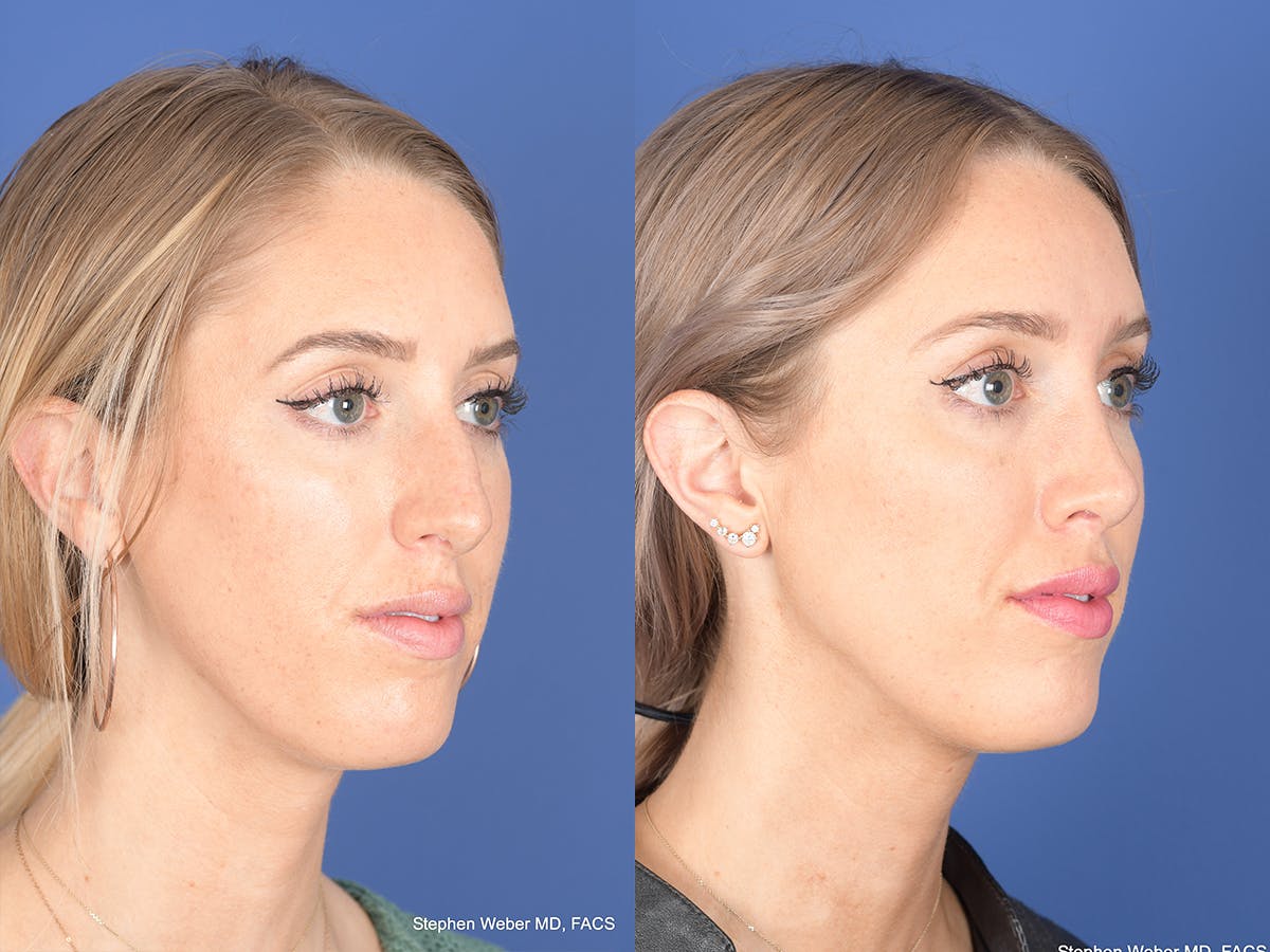 Rhinoplasty Before & After Gallery - Patient 306018 - Image 4