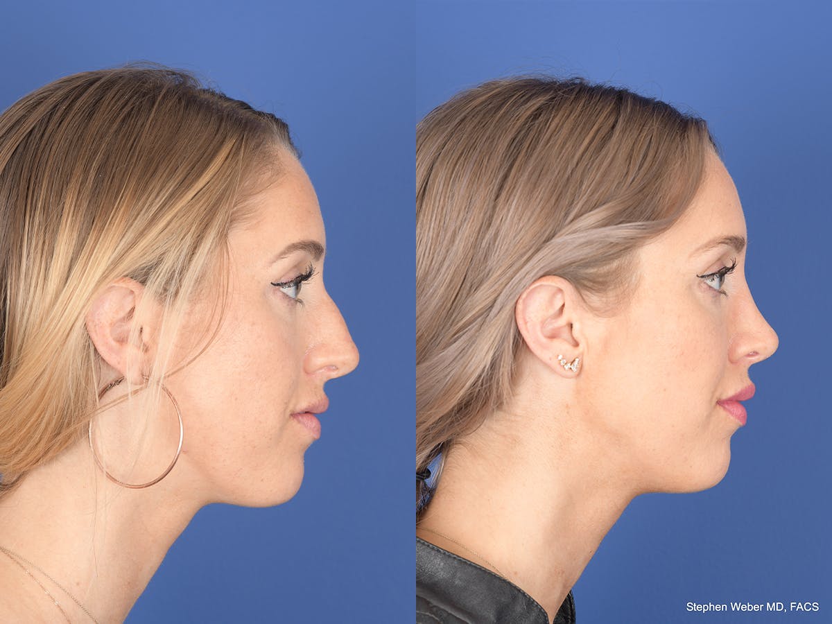 Rhinoplasty Before & After Gallery - Patient 306018 - Image 5