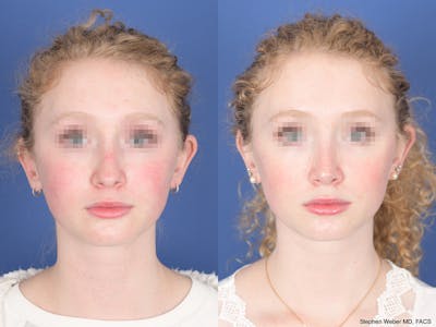 Rhinoplasty Before & After Gallery - Patient 263765 - Image 1