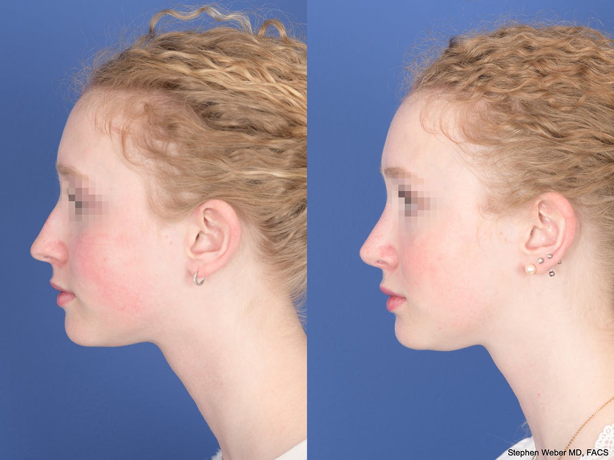 Rhinoplasty Before & After Gallery - Patient 263765 - Image 2