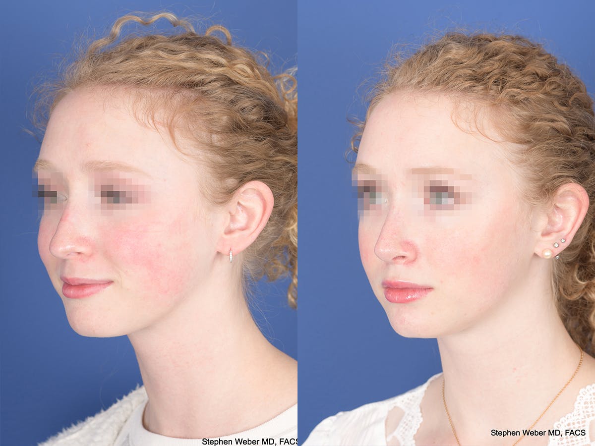 Rhinoplasty Before & After Gallery - Patient 263765 - Image 3