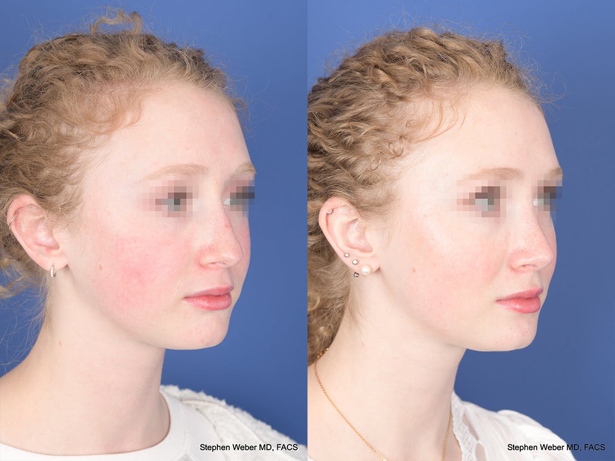 Rhinoplasty Before & After Gallery - Patient 263765 - Image 4