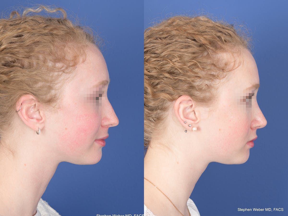 Rhinoplasty Before & After Gallery - Patient 263765 - Image 5