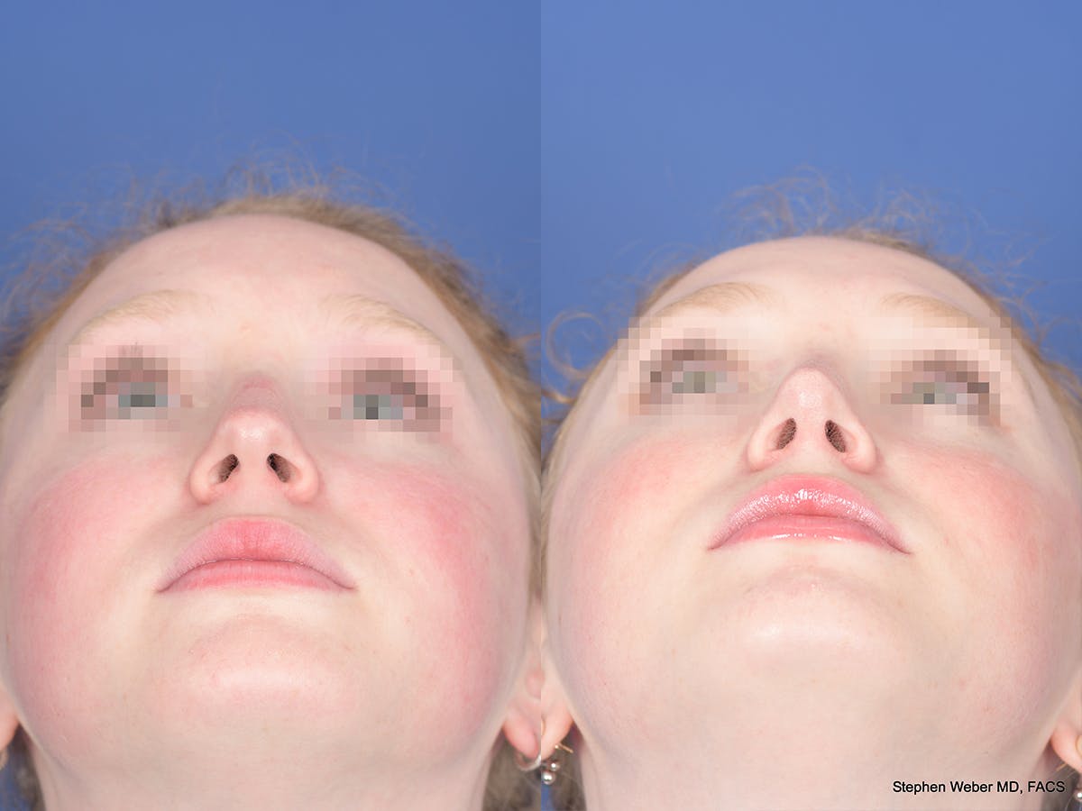 Rhinoplasty Before & After Gallery - Patient 263765 - Image 6