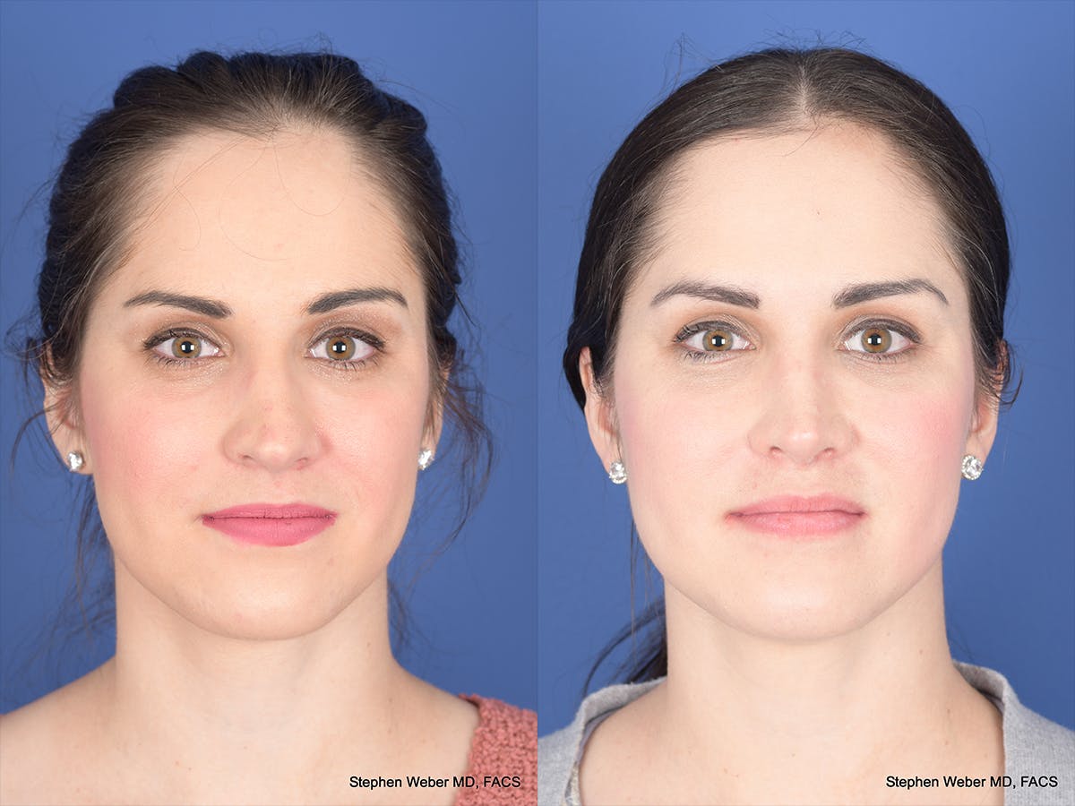 Rhinoplasty Before & After Gallery - Patient 428653 - Image 1