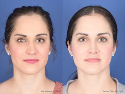 Rhinoplasty Before & After Gallery - Patient 428653 - Image 1