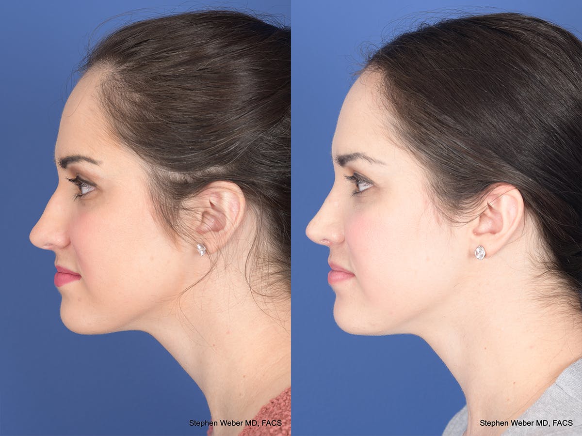 Rhinoplasty Before & After Gallery - Patient 428653 - Image 2