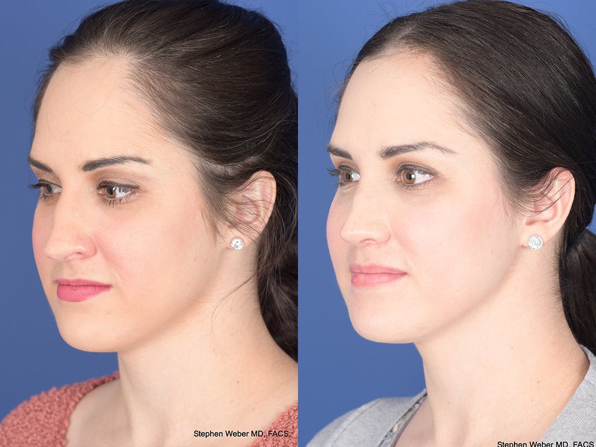 Rhinoplasty Before & After Gallery - Patient 428653 - Image 3