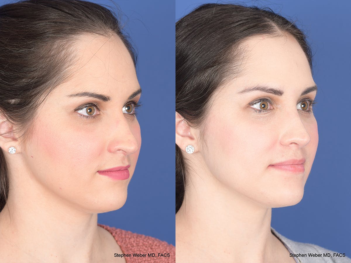 Rhinoplasty Before & After Gallery - Patient 428653 - Image 4
