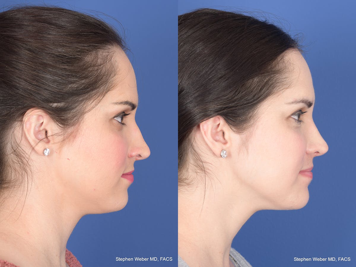 Rhinoplasty Before & After Gallery - Patient 428653 - Image 5