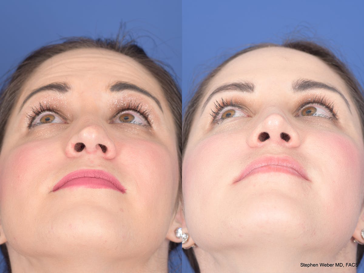 Rhinoplasty Before & After Gallery - Patient 428653 - Image 6