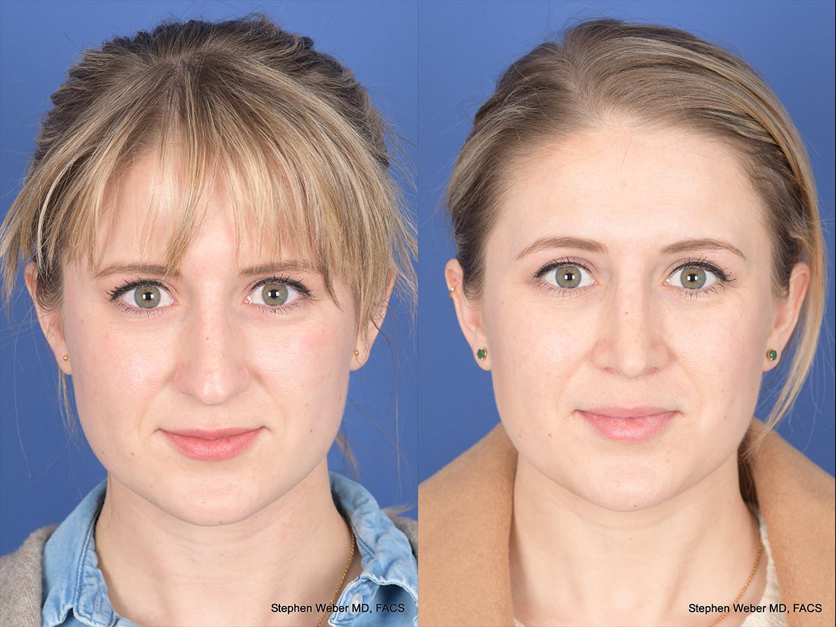 Rhinoplasty Before & After Gallery - Patient 292975 - Image 1