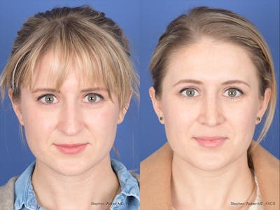 Rhinoplasty Before & After Gallery - Patient 292975 - Image 1