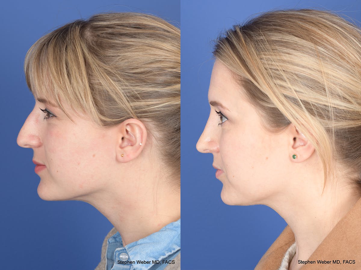 Rhinoplasty Before & After Gallery - Patient 292975 - Image 2
