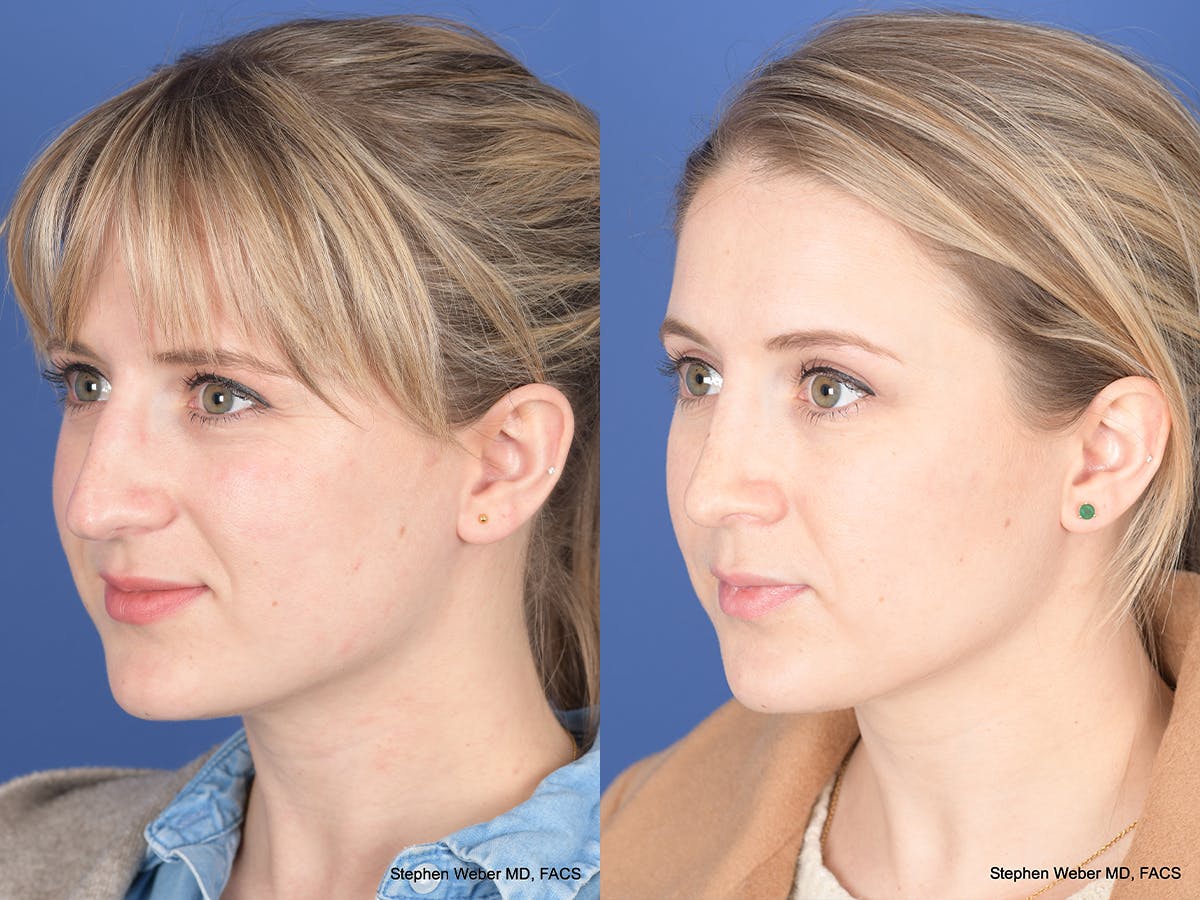 Rhinoplasty Before & After Gallery - Patient 292975 - Image 3