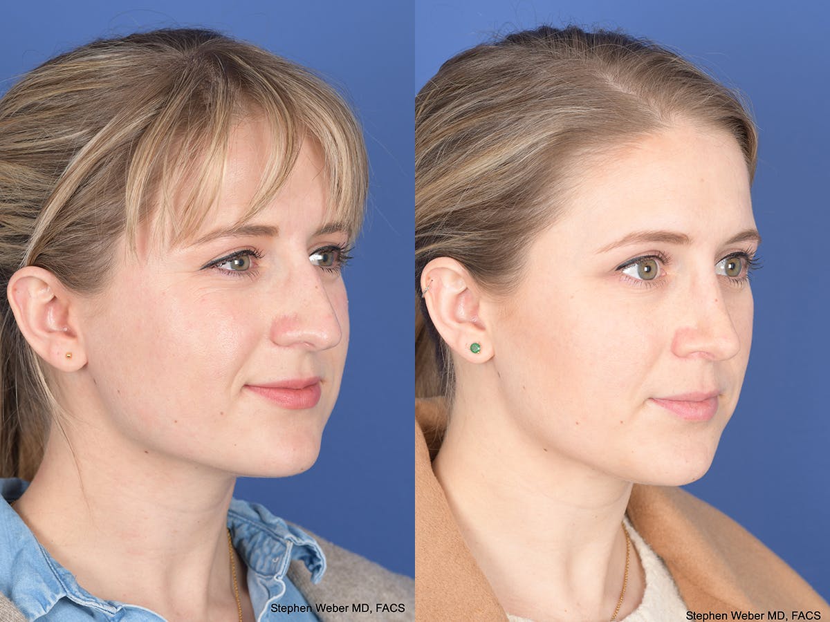 Rhinoplasty Before & After Gallery - Patient 292975 - Image 4