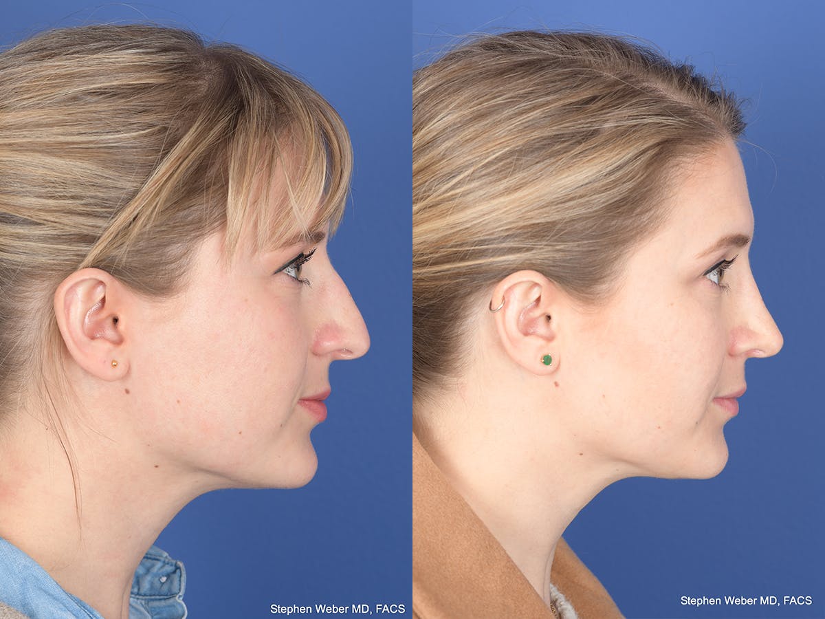 Rhinoplasty Before & After Gallery - Patient 292975 - Image 5