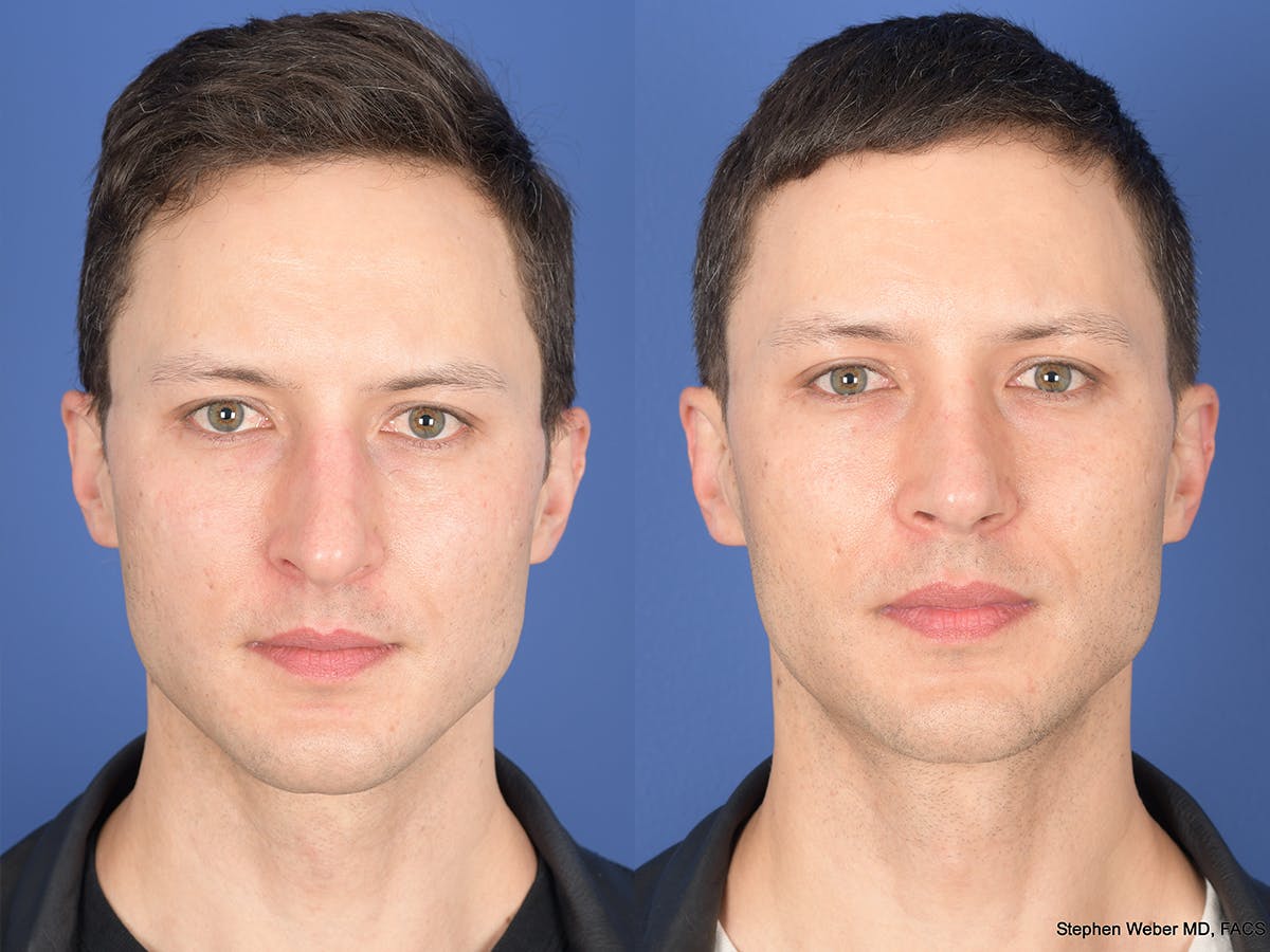 Rhinoplasty Before & After Gallery - Patient 160231 - Image 1