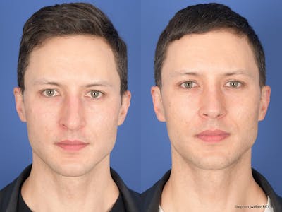 Rhinoplasty Before & After Gallery - Patient 160231 - Image 1