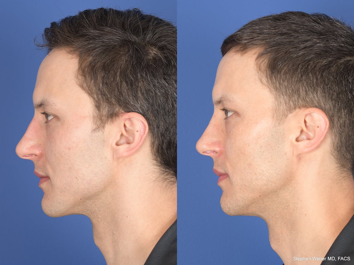 Rhinoplasty Before & After Gallery - Patient 160231 - Image 2