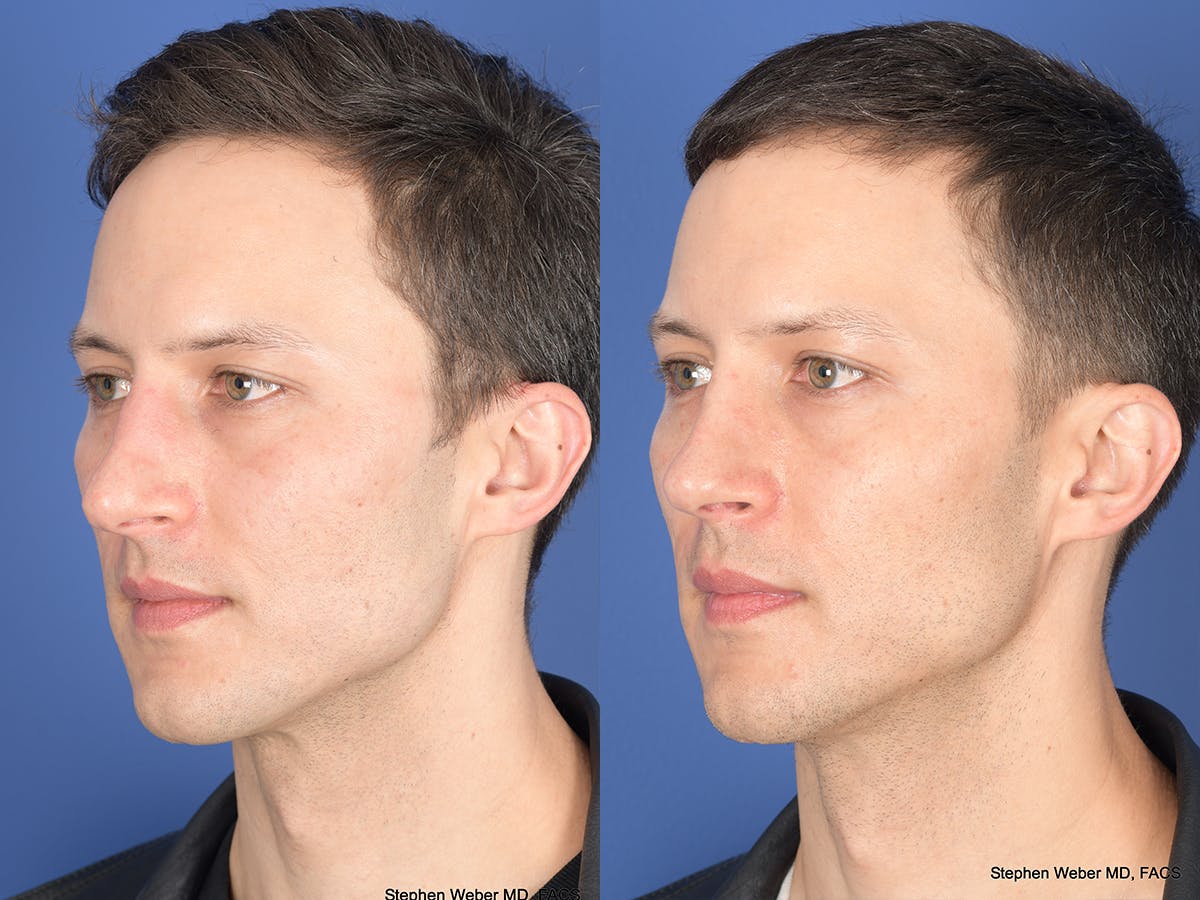 Rhinoplasty Before & After Gallery - Patient 160231 - Image 3