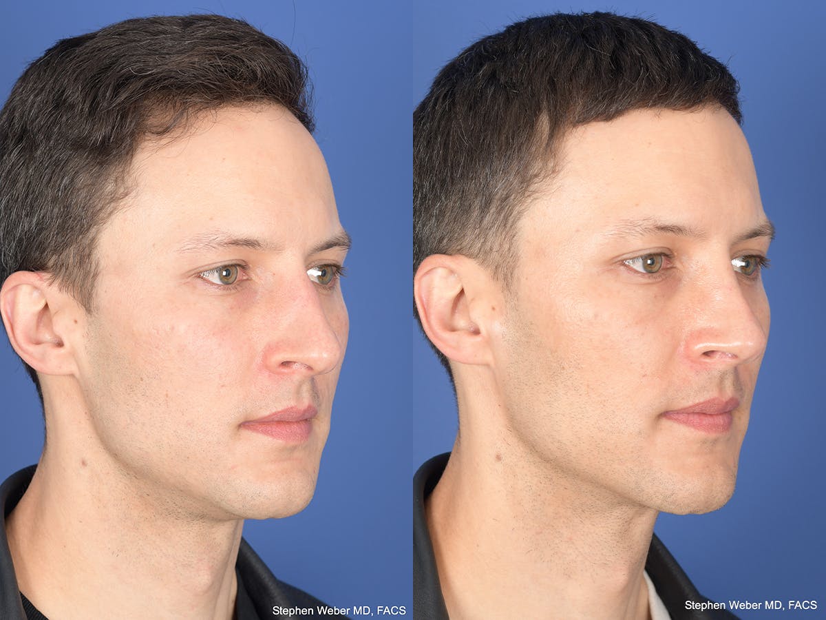 Rhinoplasty Before & After Gallery - Patient 160231 - Image 4