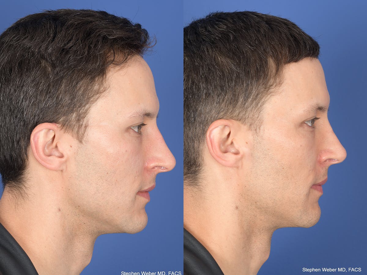 Rhinoplasty Before & After Gallery - Patient 160231 - Image 5