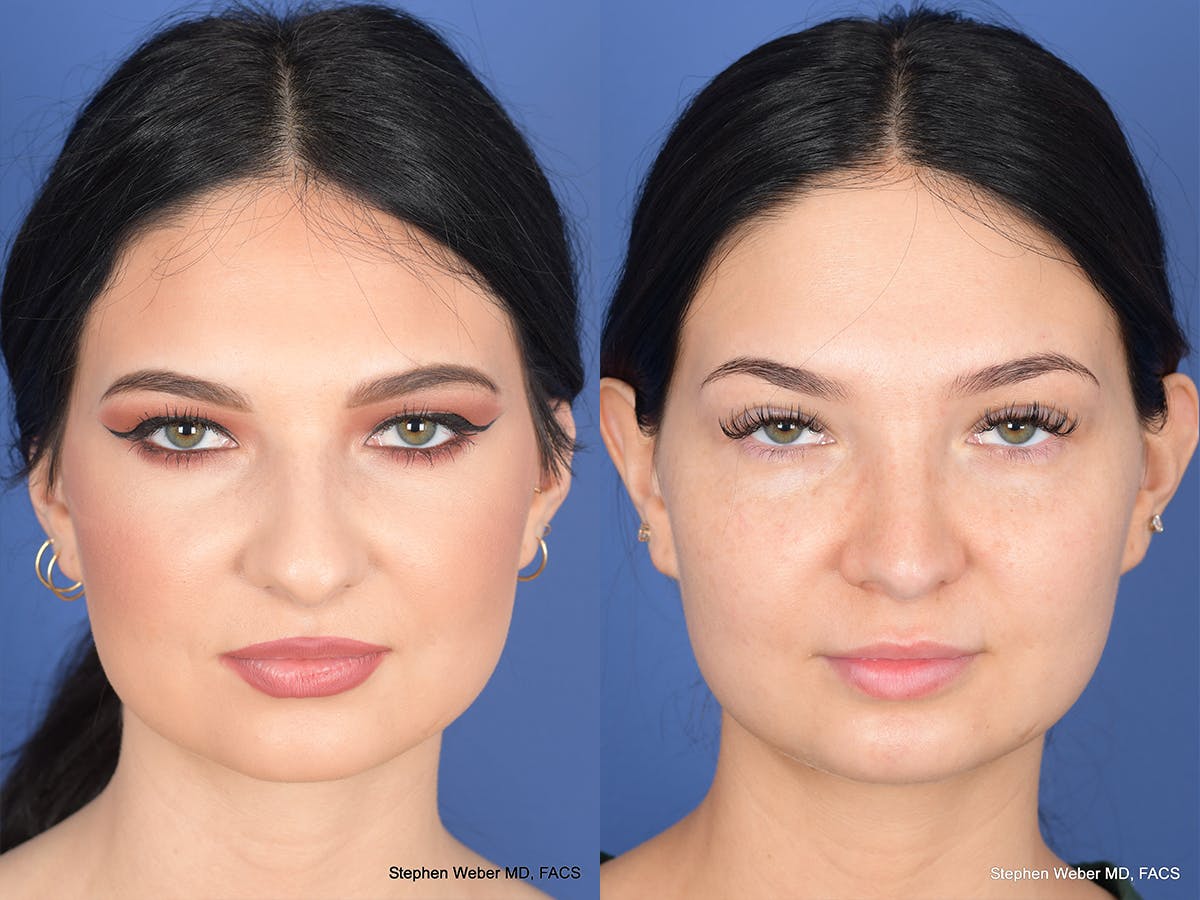 Rhinoplasty Before & After Gallery - Patient 312504 - Image 1