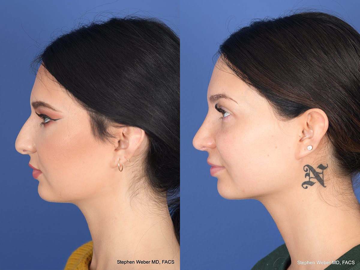 Rhinoplasty Before & After Gallery - Patient 312504 - Image 2