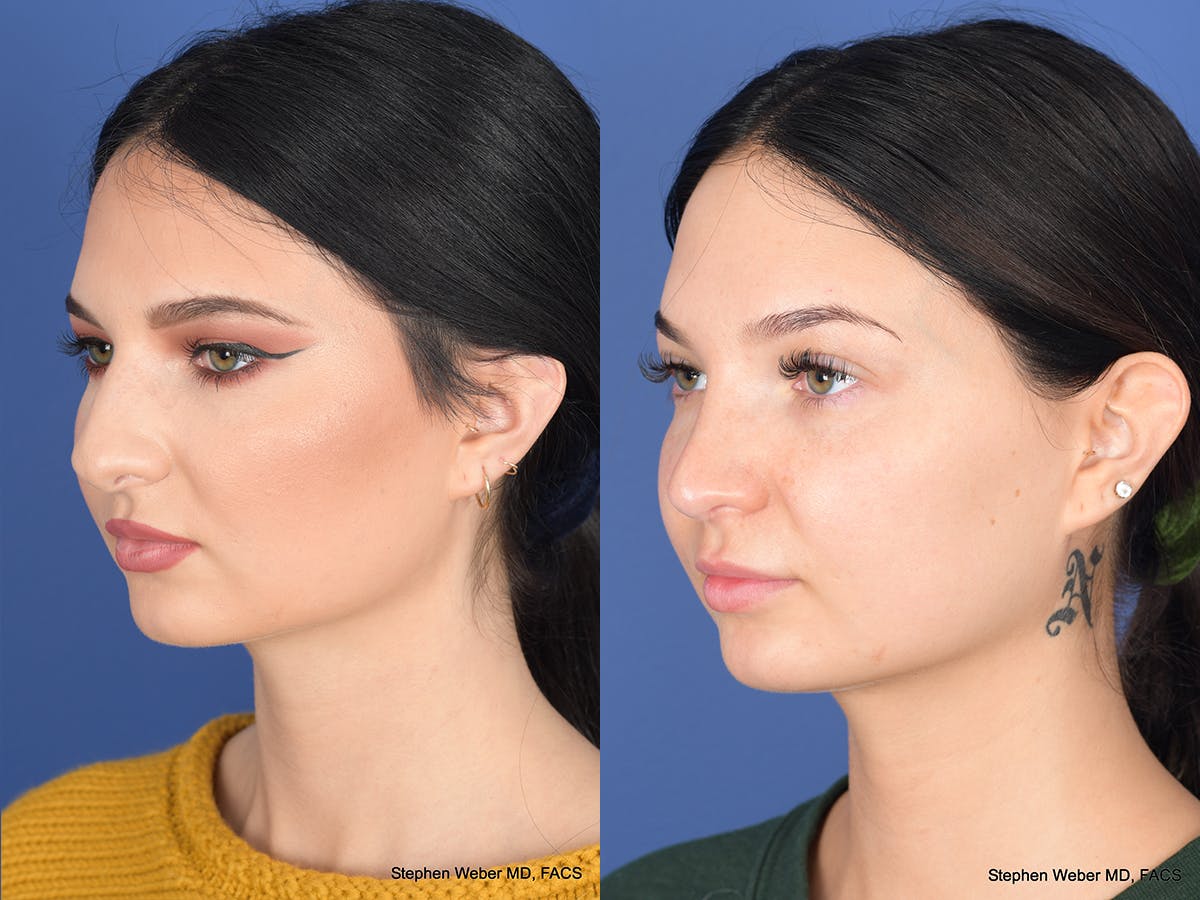 Rhinoplasty Before & After Gallery - Patient 312504 - Image 3