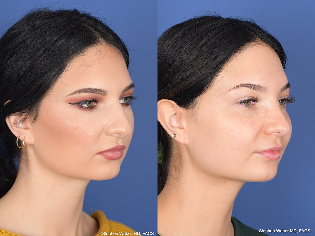 Rhinoplasty Before & After Gallery - Patient 312504 - Image 4