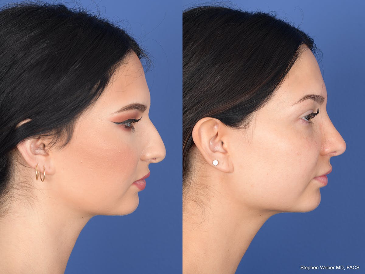 Rhinoplasty Before & After Gallery - Patient 312504 - Image 5
