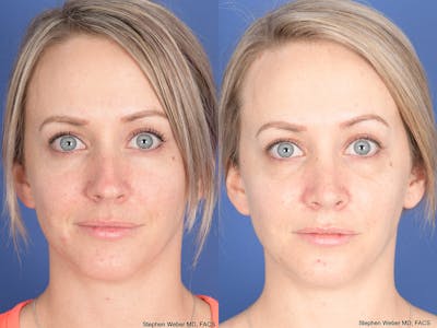 Rhinoplasty Before & After Gallery - Patient 217488 - Image 1