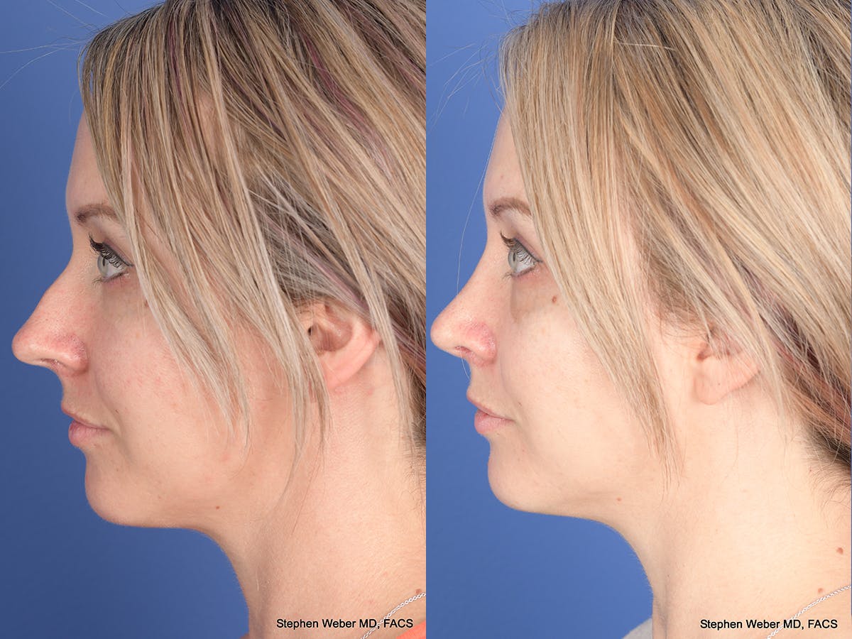 Rhinoplasty Before & After Gallery - Patient 217488 - Image 2