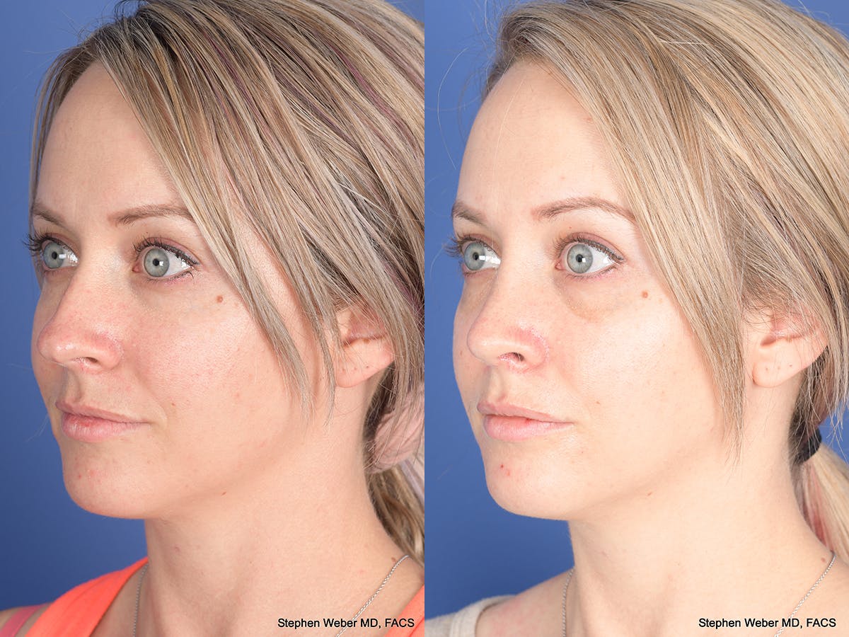 Rhinoplasty Before & After Gallery - Patient 217488 - Image 3