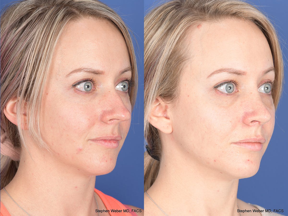 Rhinoplasty Before & After Gallery - Patient 217488 - Image 4