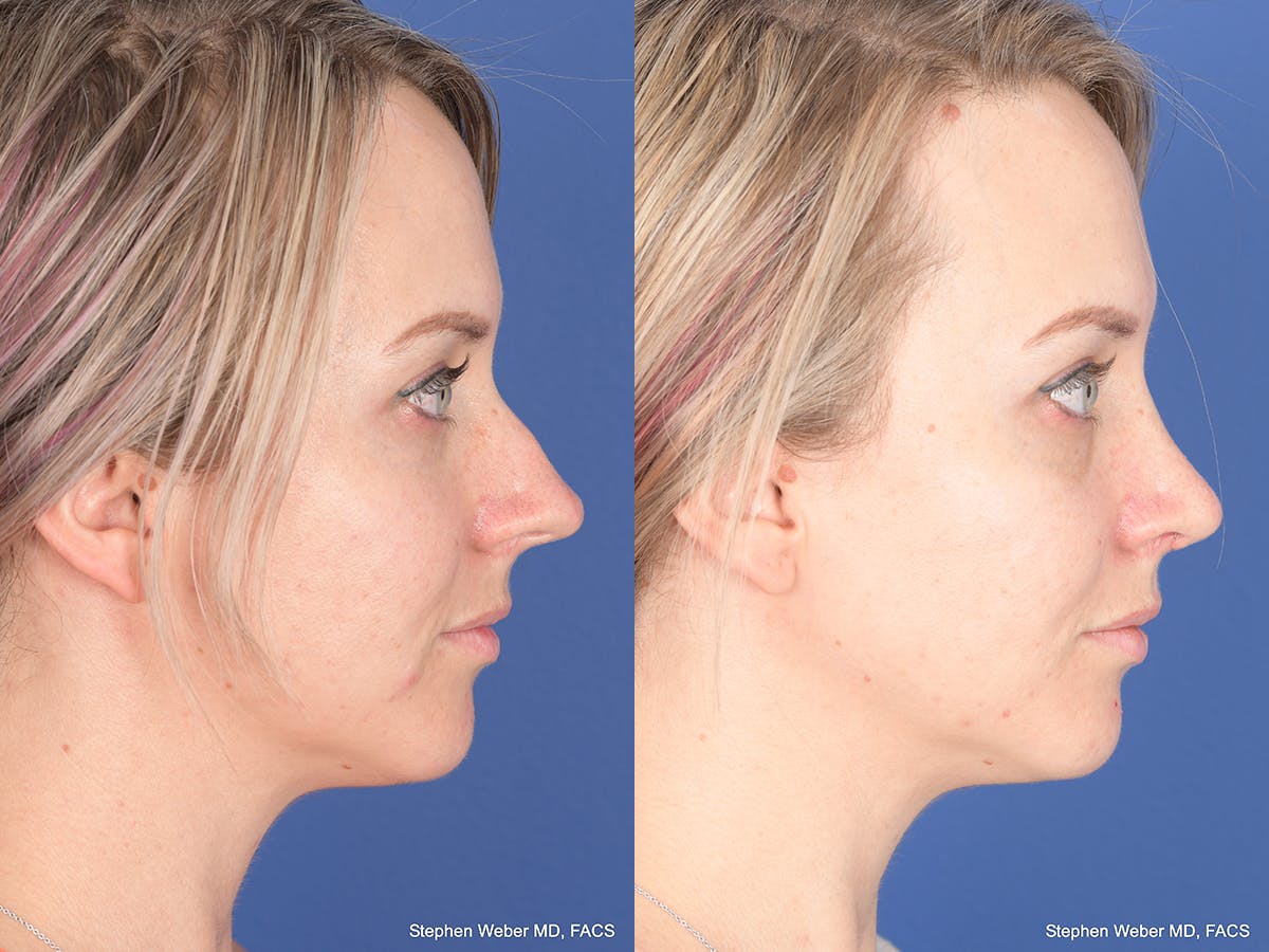 Rhinoplasty Before & After Gallery - Patient 217488 - Image 5