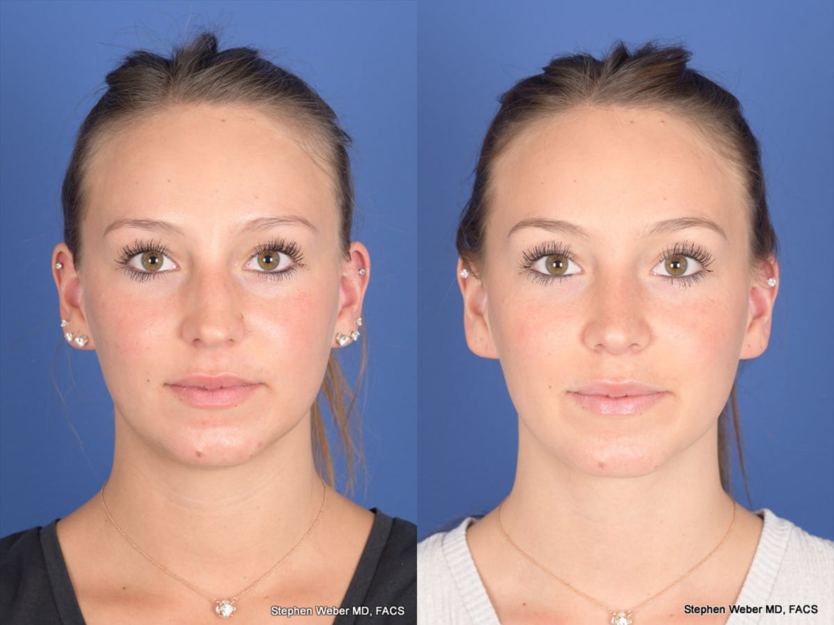 Rhinoplasty Before & After Gallery - Patient 126858 - Image 1