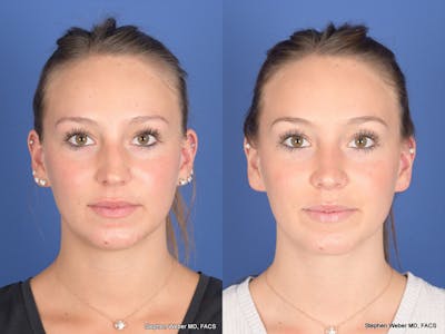 Rhinoplasty Before & After Gallery - Patient 126858 - Image 1